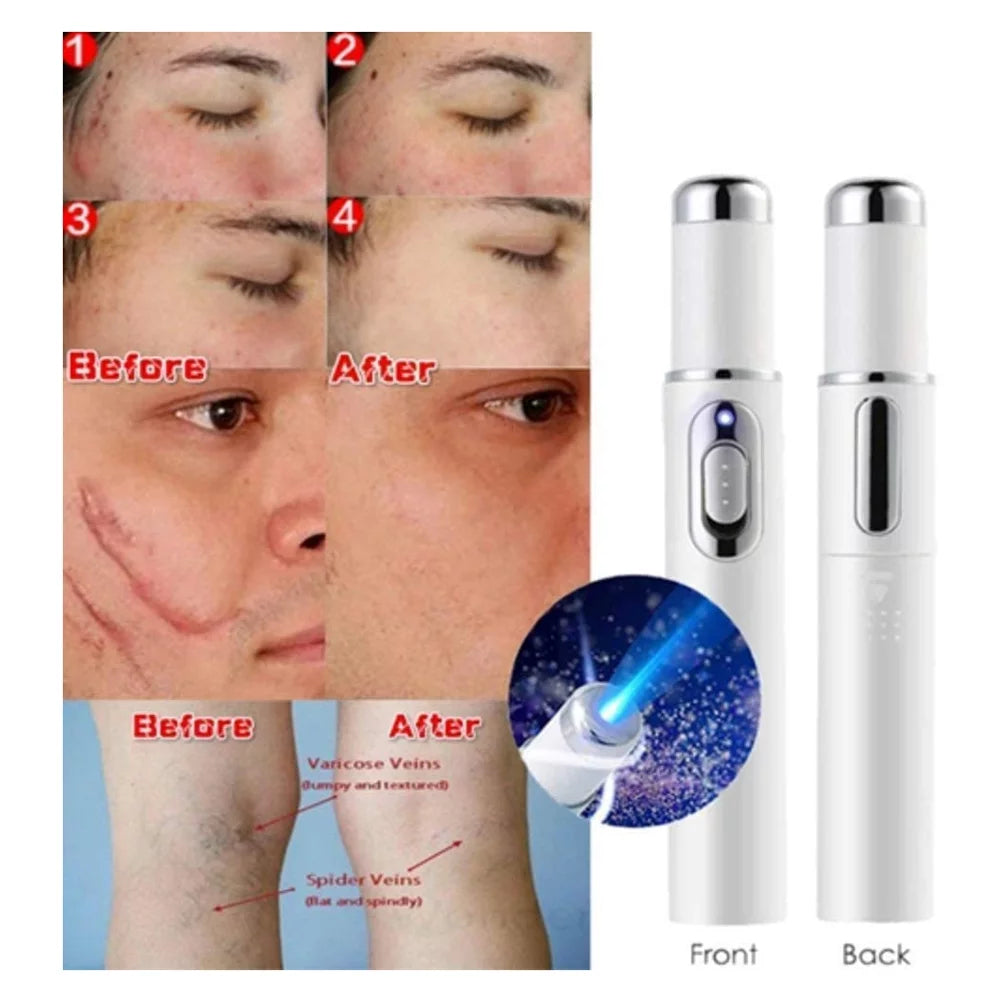 Blue Light Acne Removing Pen - Multi-Function Skincare Device for Acne - Varicose Veins - Scars and Wrinkles - Blue Light Acne Removing Pen Price in Pakistan