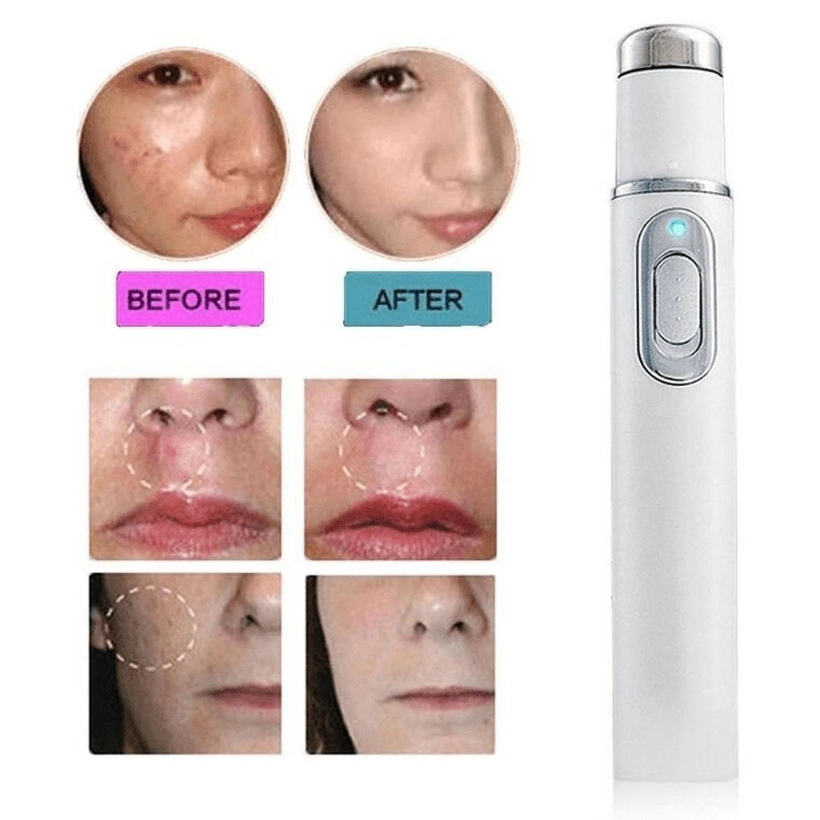 Blue Light Acne Removing Pen - Multi-Function Skincare Device for Acne - Varicose Veins - Scars and Wrinkles - Blue Light Acne Removing Pen Price in Pakistan