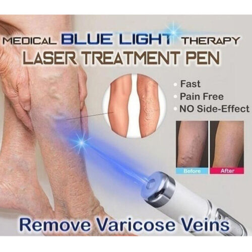 Blue Light Acne Removing Pen - Multi-Function Skincare Device for Acne - Varicose Veins - Scars and Wrinkles - Blue Light Acne Removing Pen Price in Pakistan