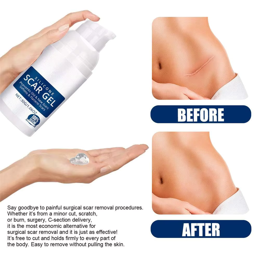 Silicone Scar Removal Cream Gel Burn Surgical Scar Cesarean Repairing Stretch Marks Whitening Pigmentation Corrector - Silicone Scar Removal Gel in Pakistan - Scar Removal Cream Supplies