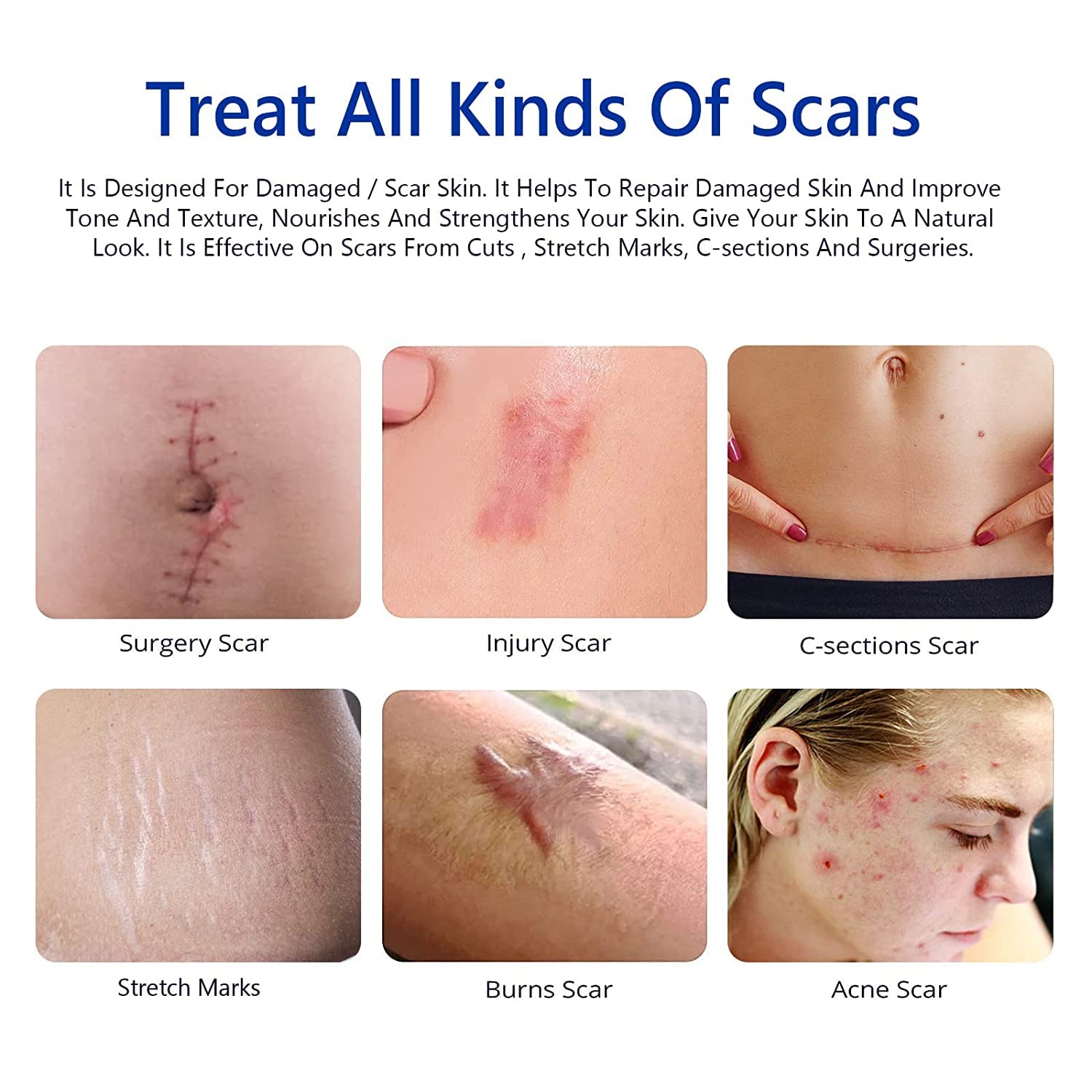 laser scar 𝗦𝗰𝗮𝗿 𝗿𝗲𝗰𝗼𝘃𝗲𝗿𝘆 𝗾𝘂𝗶𝗰𝗸 - 𝗿𝗲𝗺𝗼𝘃𝗮𝗹 𝗼𝗳 𝘀𝘂𝗿𝗴𝗶𝗰𝗮𝗹 𝘀𝗰𝗮𝗿𝘀 𝘀𝘁𝗿𝗲𝘁𝗰𝗵 - 𝗺𝗮𝗿𝗸𝘀 𝗯𝘂𝗿 𝗦𝗰𝗮𝗿 𝗿𝗲𝗰𝗼𝘃𝗲𝗿𝘆 𝗾𝘂𝗶𝗰𝗸 - price in Pakistan